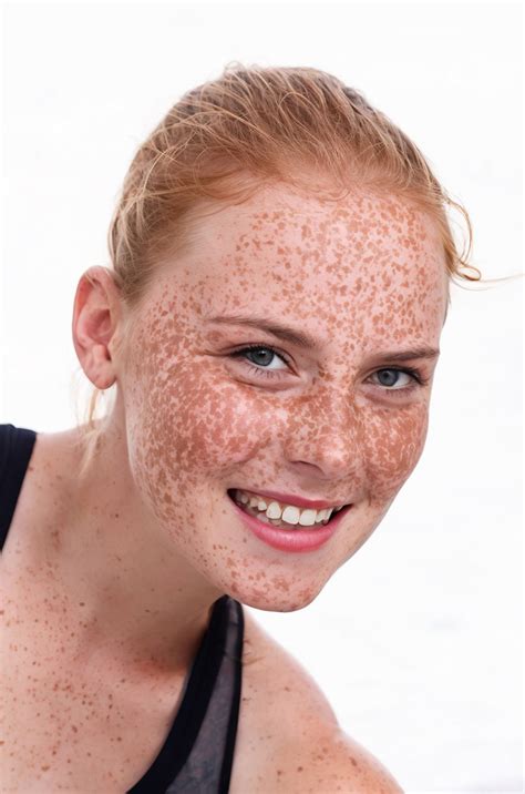 how to eliminate freckles 3