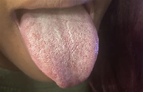 Is this oral thrush? : r/Candida