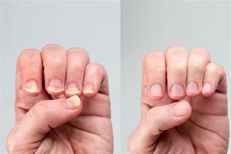Nail Abnormalities | Your nails can reveal your health condition, so ...