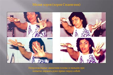Малая хорея: причины, симптомы, диагностика и лечение