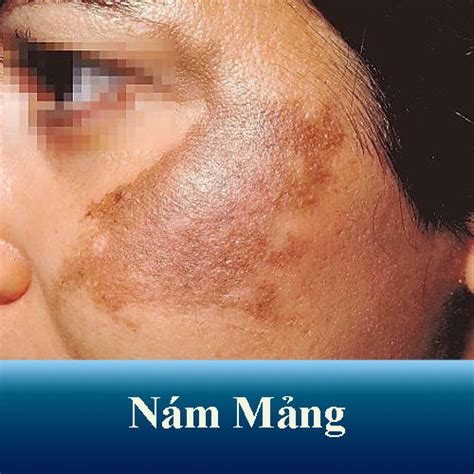 nam mang nguyen nhan va phuong phap dieu tri
