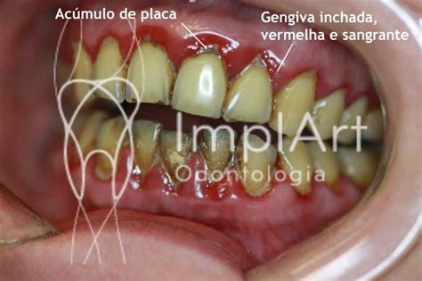 Gengiva Inflamada E Doendo - gengivite_gengiva_inflamada_vermelha_48kb - ImplArt