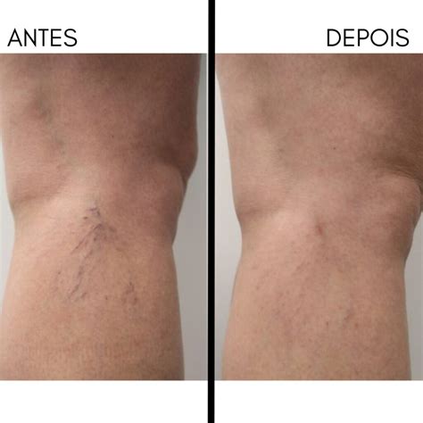 Secagem De Vasinhos Antes E Depois - Tudo sobre Secagem de Vasinhos PEIM. Secagem de Vasinhos Procedimento