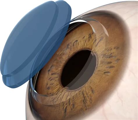 Cornea Specialists in India | Advanced Keratoconus Treatments & Corneal ...