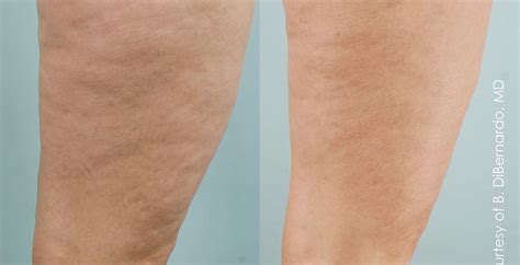Cellulaze Before & After | Kerin Medspa & Laser Center