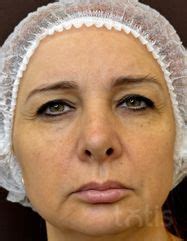 ᐉ TESSLIFT Набір TESSLIFT SOFT V-DERM (10 ниток) + Бандаж + канюля ...