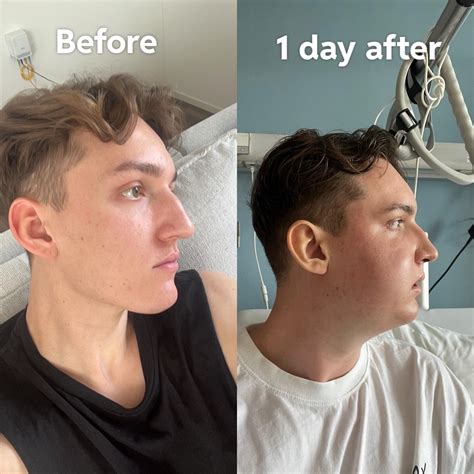 1 day after double jaw surgery : r/jawsurgery