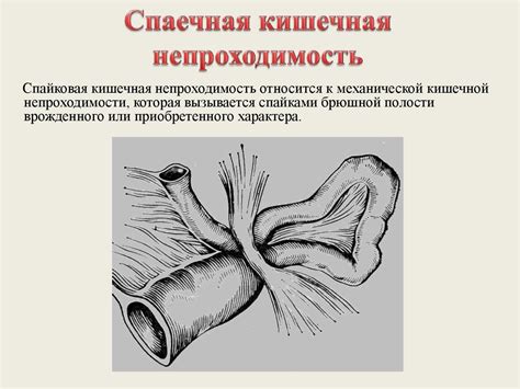 Острая кишечная непроходимость - презентация онлайн
