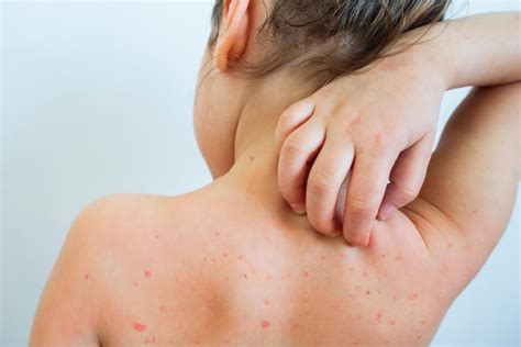Varicelle enfant : évolution et traitement