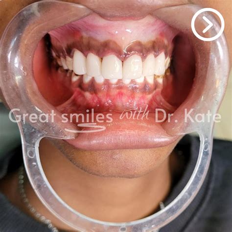Dental fluorosis causes, risk factors, and management in Kenya ...