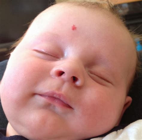 Hemangioma