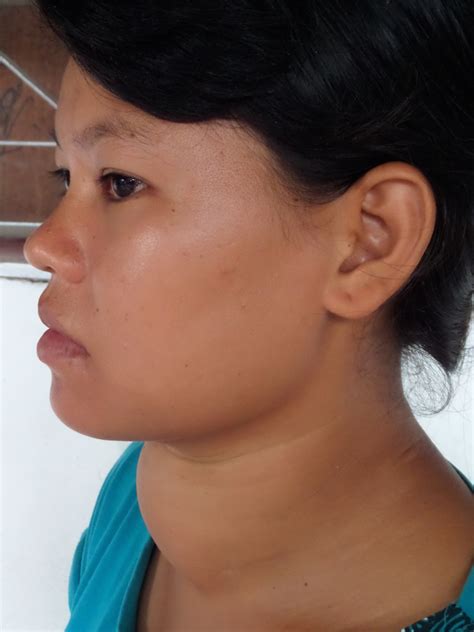 [DIAGRAM] Diagram Of Goiter - MYDIAGRAM.ONLINE