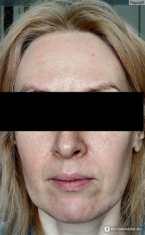 Пилинг для лица Mediderma азелаиновый - «эффективно» | отзывы