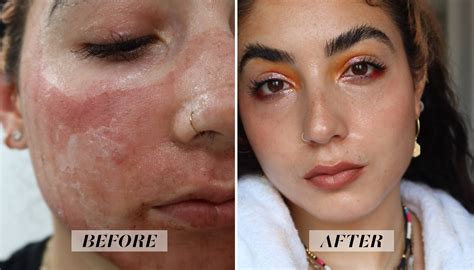 levisa lazer: Before & After Photos That Will Amaze You - 2rlq971