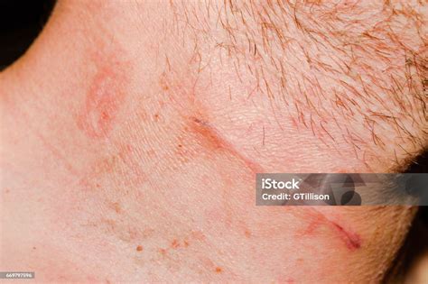 Neck Scar Stock Photo - Download Image Now - Australia, Cervical ...