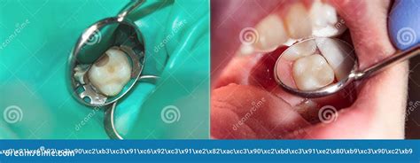 Restoration of the Tooth Close-up. the Concept of Aesthetic Treatment ...
