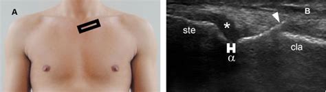 Sternoclavicular Joint | Radiology Key