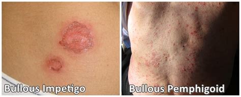Bullous Impetigo vs Bullous Pemphigoid