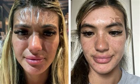 Sun Burn Face Peeling