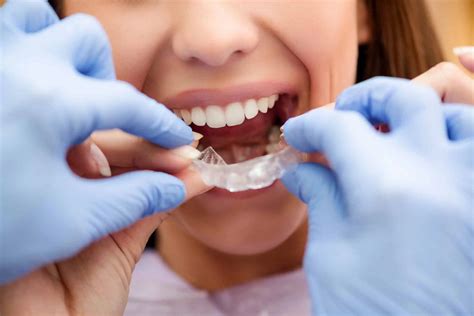 dental splints bexley dentists family  kids dentist serene dental