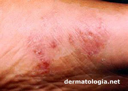 Micoses De Pele Que Coçam - Micoses superficiais da pele - Dermatologia.netDermatologia.net