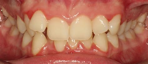 pic inline orthodontics