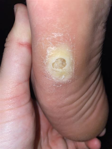 I need help identify if this is a wart : r/Warts