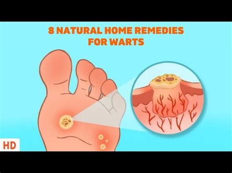 How To Treat A Planters Wart At Home
