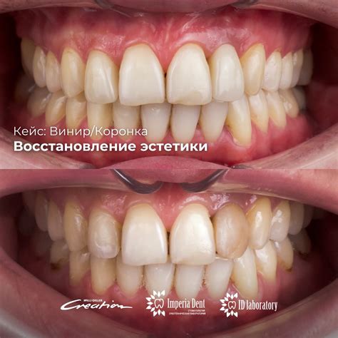 Стоматолог Муртаз-оглы Султан | Виниры | Астана | Препарирование под ...