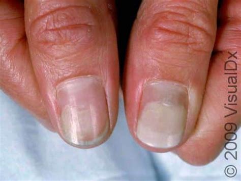 Onycholysis: Causes, Symptoms, and Treatment - Skinsight