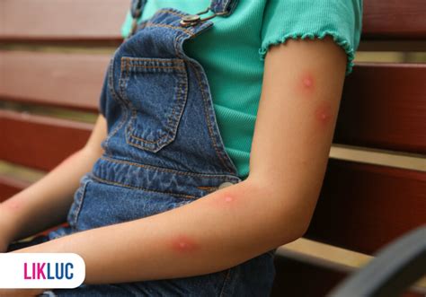 Reações Alergicas A Picadas De Insetos - Alergia à picada de inseto: reações, tratamentos e prevenção