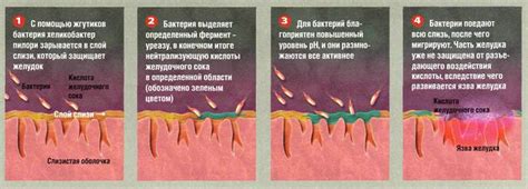 Helicobacter pylori — симптомы и диагностика хеликобактер пилори.