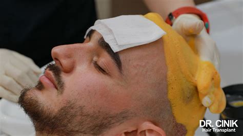 Hair transplant 5 days after - Dr Cinik