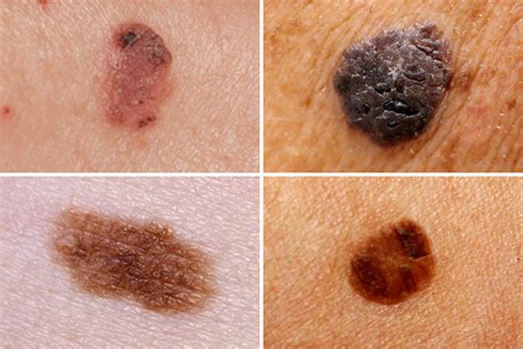 Using Dermoscopic Features to Diagnose Melanoma in Situ - Contemporary Approaches to Malignant ...