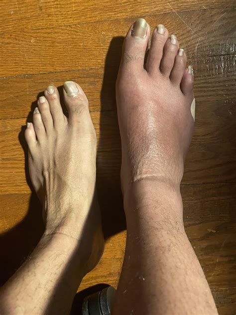 122 best r/crps images on Pholder | So sick of people telling me my