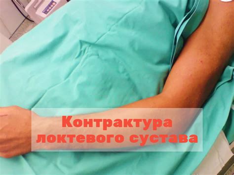 Контрактура локтевого сустава МКБ 10: причины, симптомы, лечение