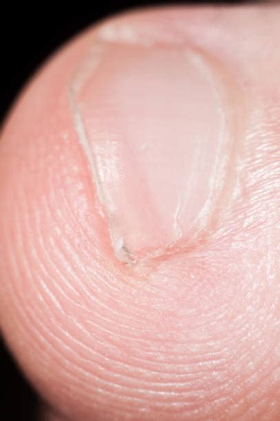 320+ Curved Toenails Stock Photos, Pictures & Royalty-Free Images - iStock