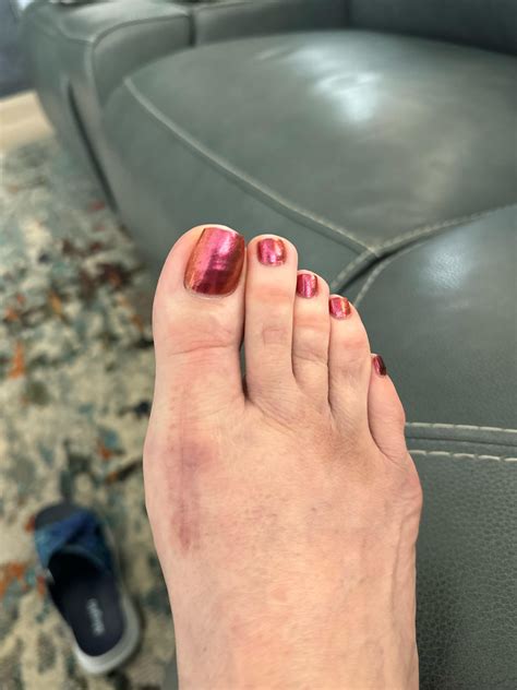 Bunions: Treatment, causes, non-surgical and surgical approaches