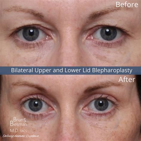 upper   eyelid surgery nashville blepharoplasty nashville