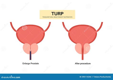 Transurethral Resection Of The Prostate Vector Illustration ...