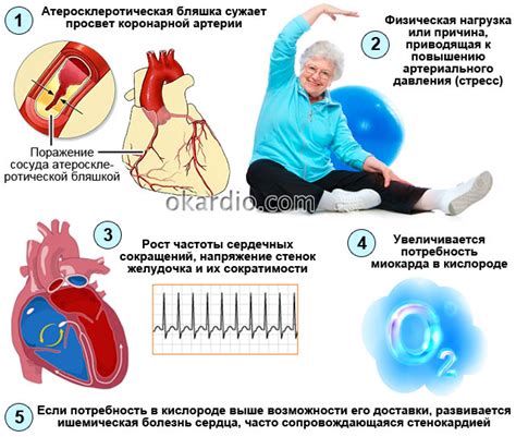 Стенокардия напряжения 2 ФК: что это такое, причины и лечение