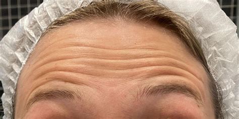 Ботокс для лица: цена в Санкт-Петербурге на процедуры по инъекции BOTOX ...
