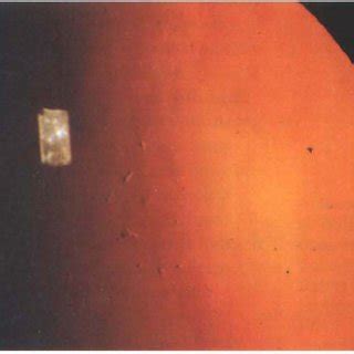 Anterior polar cataract. Retroillumination of the pymmidal cataract ...