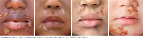 impetigo symptoms  mayo clinic