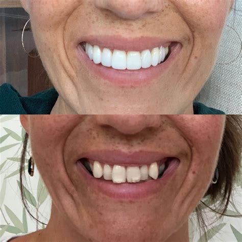 Veneers | Teeth whitening, Best dental implants, Implant dentist