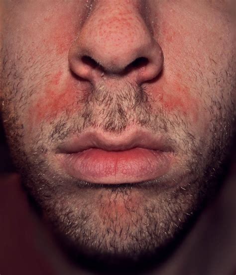 seborrheic dermatitis  rosacea rosaceaorg