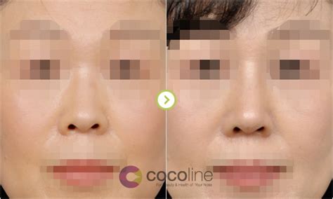 COCOLINE