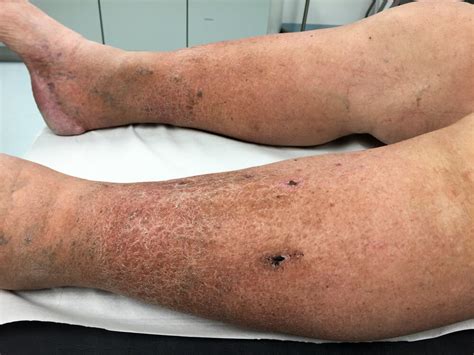 Chronic Venous Insufficiency: Early Signs and Treatment Options