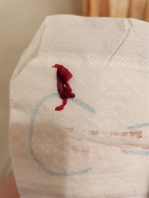 4 week miscarriage tissue