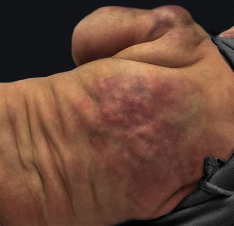 Subcutaneous fat necrosis of the newborn: clinical and